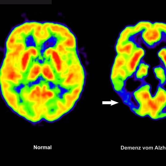 Alzheimer-Erkrankung