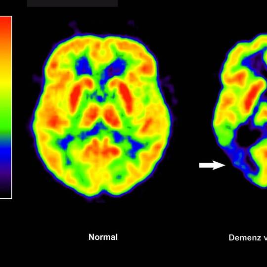 Alzheimer-Erkrankung