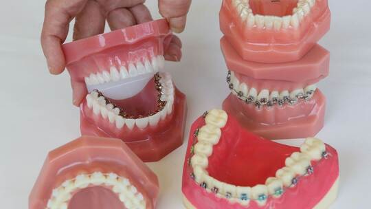 Zahnspangen Zahnspangen