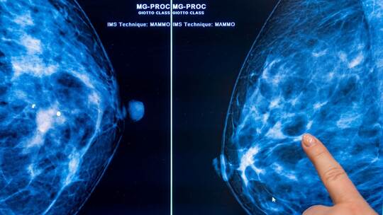 Mammographie Mammographie