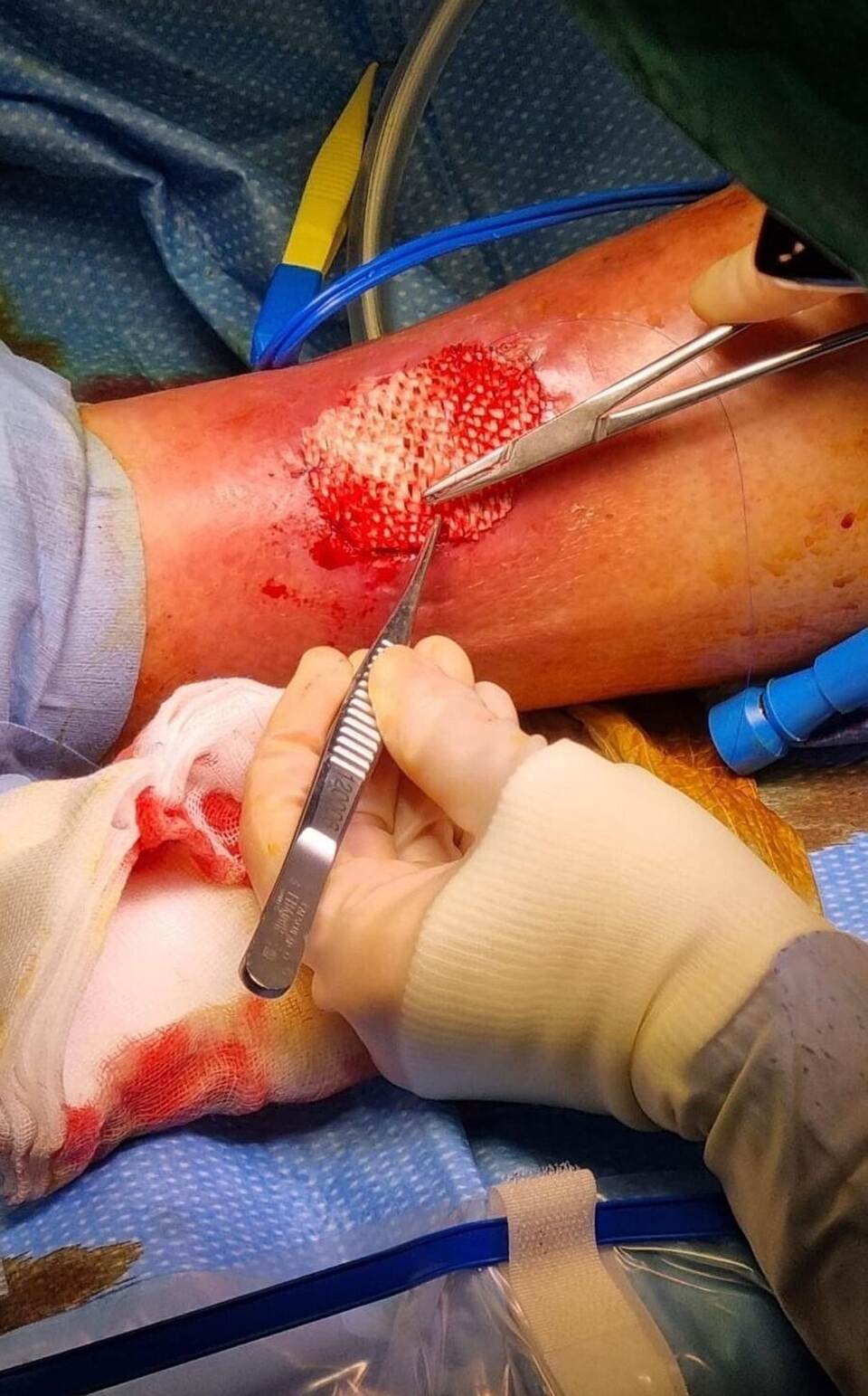 Fischhaut zur Behandlung von großen Wunden Fischhaut zur Behandlung von großen Wunden